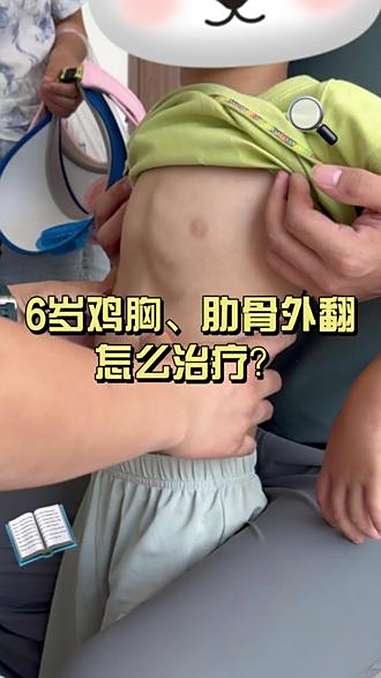 6 岁鸡胸、肋骨外翻怎么治疗 抖出健康知识宝藏 儿童胸外科李飞 鸡胸 漏斗胸 肋骨外翻