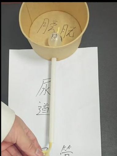 拔尿管 尿管