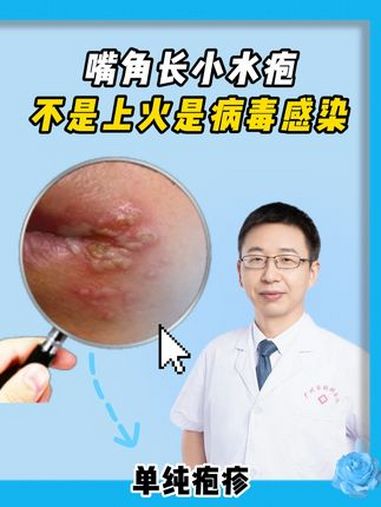 嘴角长透明小水疱,要注意可能是病毒感染会传染。单纯疱疹 医学科普 抖出健康知识宝藏