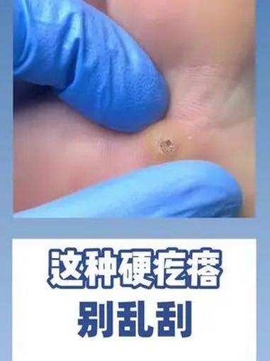 HPV