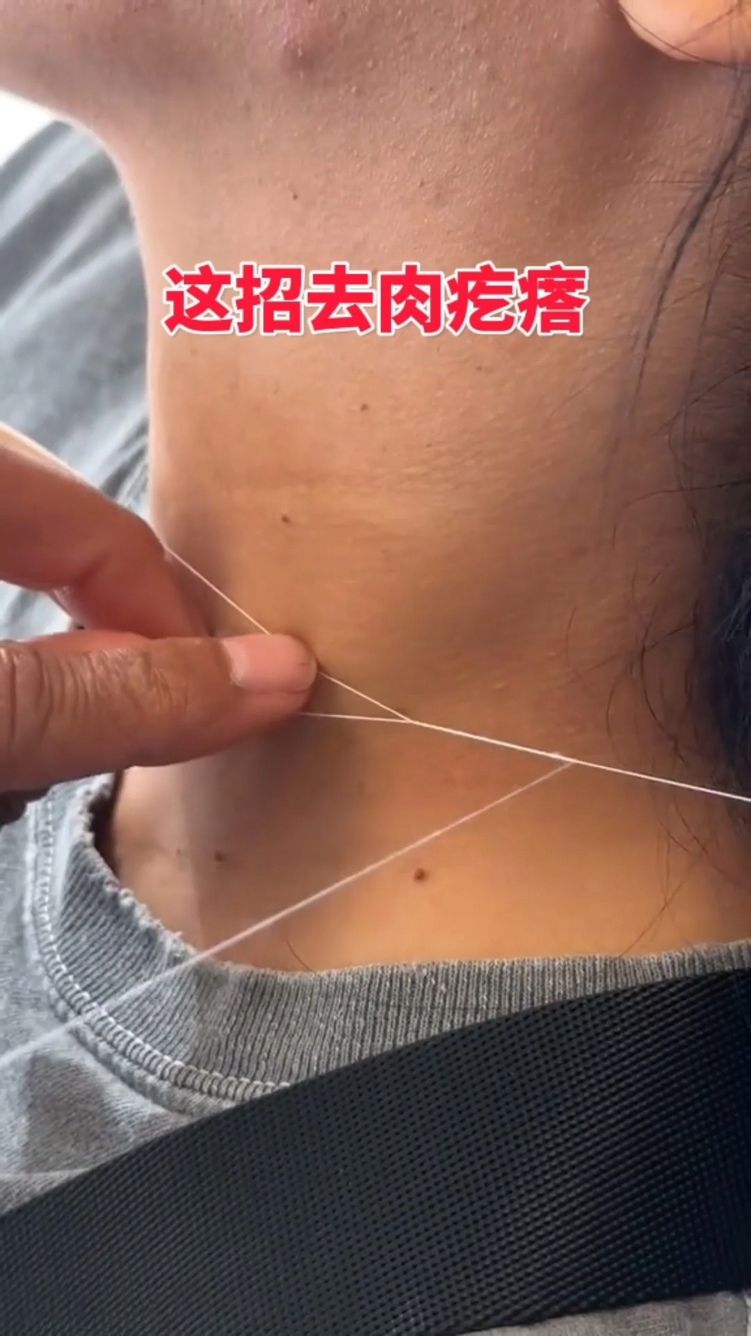 小伙这招去肉疙瘩