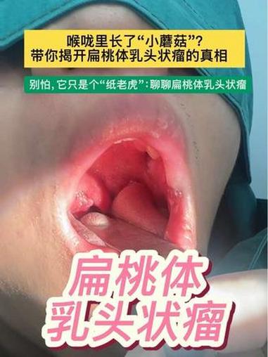 喉咙里长了“小蘑菇”?带你揭开扁桃体乳头状瘤的真相 别怕,它只是个“纸老虎”:聊聊扁桃体乳
