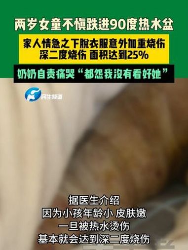 4月5日(发布)河南郑州,两岁女童不慎跌进90度热水盆。家人情急之下脱衣服意外加重烧伤,深