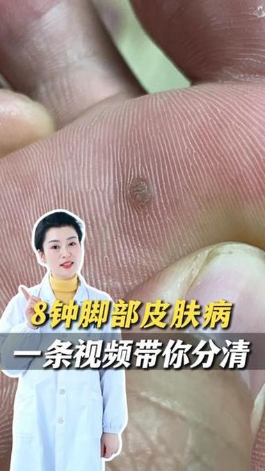 医学科普 hpv 鸡眼 涨知识