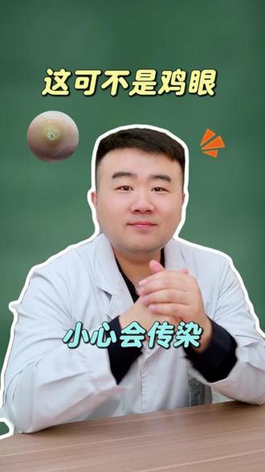 这可不是鸡眼，小心会传染#鸡眼 #医学科普 #涨知识 #硬核健康科普行动 #抖出健康知识宝