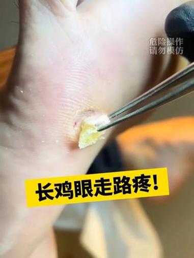 长了鸡眼别乱挖，医生教你快速处理#鸡眼 #鸡眼去除小妙招 #医学科普 #涨知识 #健康