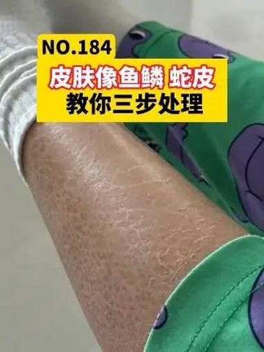 冬天皮肤像鱼鳞、蛇皮一样,这是皮肤病,医生教你三步处理