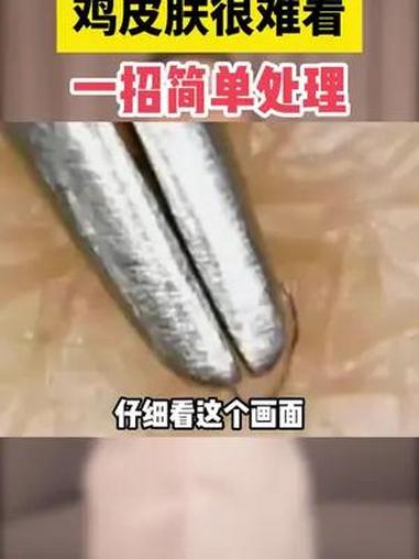 鸡皮肤很难看,医生教你一招简单处理