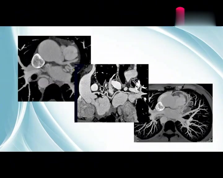 [图]「放射诊断学」心脏与大血管讲解 (6)