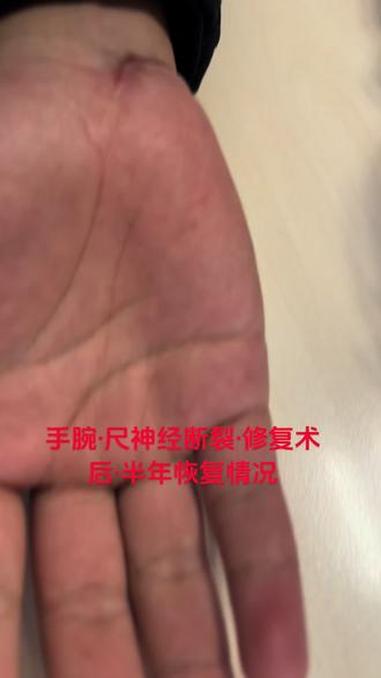 尺神经修复与康复 #尺神经损伤 #爪形手 #尺神经 #手指麻木 #武汉协和医院李涛