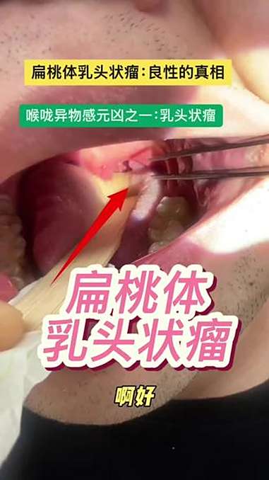扁桃体乳头状瘤:良性的真相 喉咙异物感元凶之一:乳头状瘤 医者精神以爱为光 抖出健康知识宝