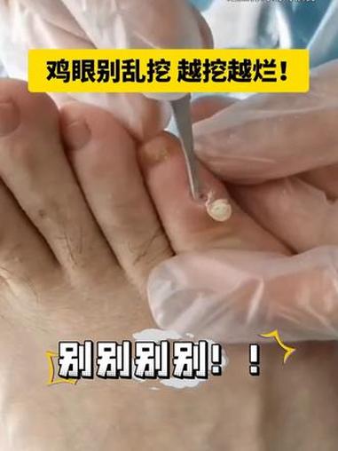 长了鸡眼千万别乱挖，教你几步在家无痛处理！#医学科普 #鸡眼 #鸡眼去除小妙招 #健康科普