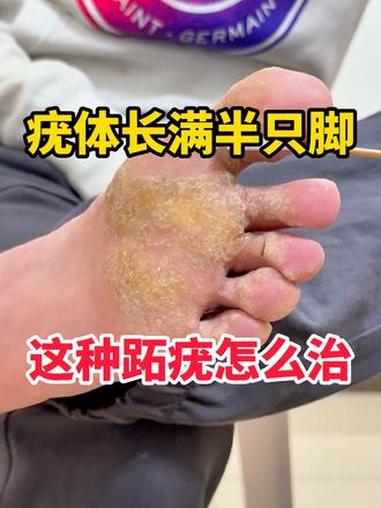 疣体长满半只脚 这种跖疣怎么治 #跖疣 #hpv #疣体 #抖出健康知识宝藏 #新年囤点专