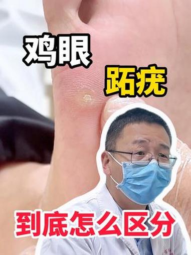 鸡眼 跖疣 到底怎么区分 #鸡眼 #跖疣 #hpv #抖出健康知识宝藏 #医疗健康创作训练