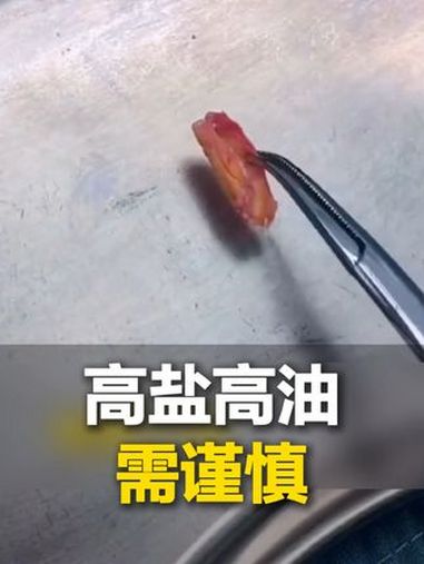 医生展示从血管中取出的粥样硬化斑块,手捏不碎 敲起来邦邦响,高油高盐的后果太吓人!
