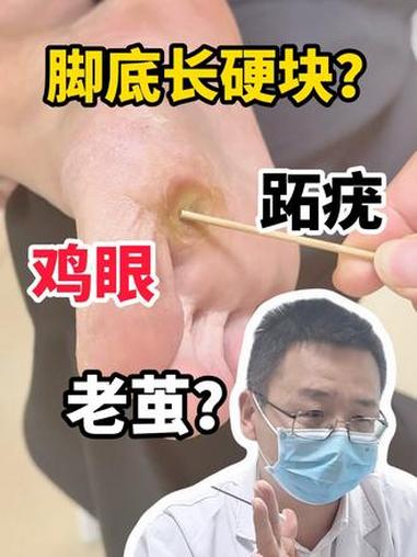 脚底长硬块？鸡眼 跖疣还是老茧 鸡眼 跖疣 老茧 抖出健康知识宝藏 我的年度健康盘点