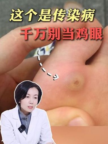 这可不是鸡眼,小心传染,还越长越多!一条视频教你处理~ 跖疣 鸡眼 医学科普 hpv 抖出