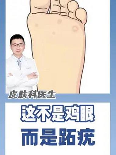 这不是鸡眼 而是跖疣 这不是鸡眼 而是跖疣
