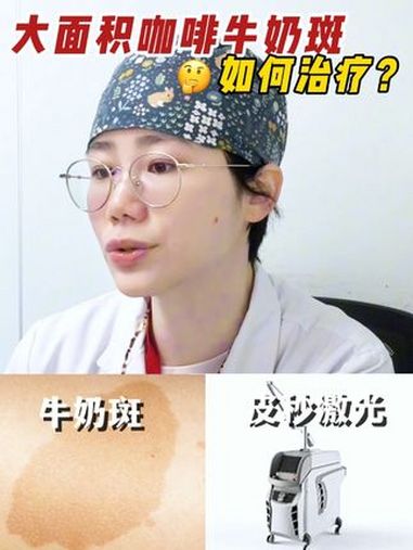 大面积咖啡牛奶斑如何治疗?硬核健康科普行动 医美 医学科普 皮秒