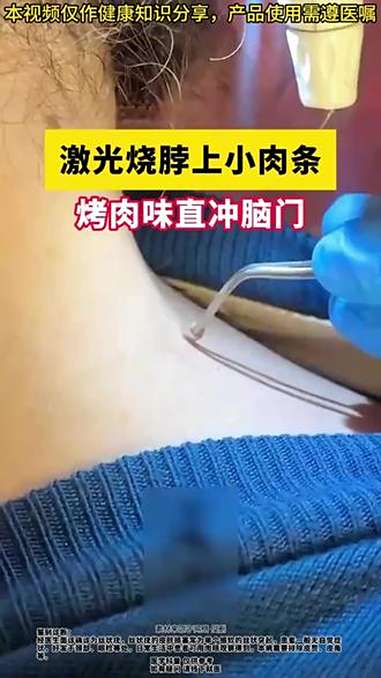 脖子腋下长肉粒,是感染hpv的信号,要注意 免疫问题!hpv病毒感染 丝状疣 抖出健康知识