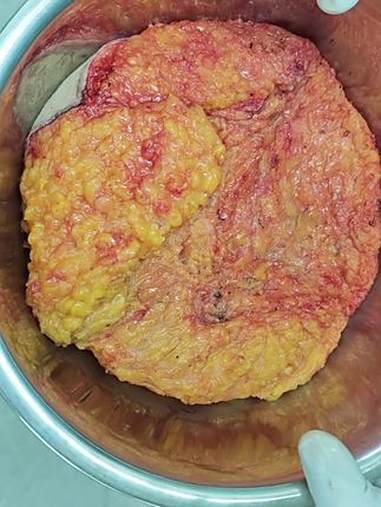 原来脂肪这么占体积?减肥 这就是2斤脂肪的体积,满满一盆。昨天手术切异常胸壁,都是脂肪,刚