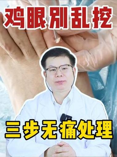 脚上长了鸡眼千万别乱挖，教你几步在家无痛处理！#医学科普 #鸡眼 #鸡眼去除小妙招 #健康