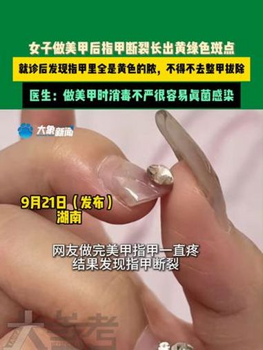 9月21日发布,湖南。女子做美甲后指甲断裂长出黄绿色斑点。就诊后发现指甲全是黄色的脓,不得