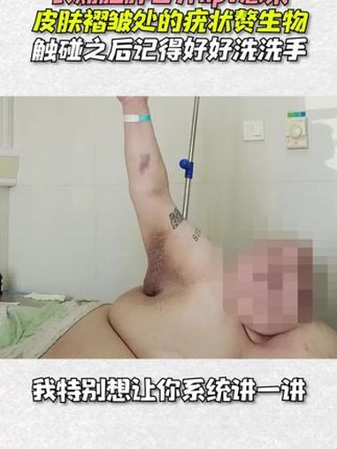 丝状疣