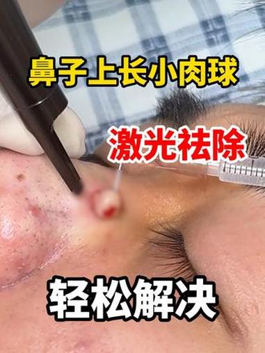 鼻子上长小肉球 激光祛除 轻松解决 #软纤维瘤 #鼻子上长了一个包 #激光 #抖出健康知识