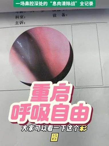 给鼻子做个“大扫除”：鼻息肉手术全揭秘 重启呼吸自由 一场鼻腔深处的“息肉清除战”全记录 