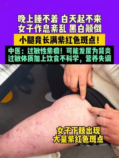 3月13日,河南郑州,晚上睡不着,白天起不来,女子作息紊乱黑白颠倒,小腿竟长满紫红色斑点!