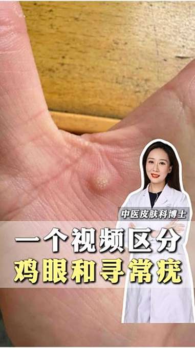 鸡眼vs寻常疣,别再傻傻分不清啦!鸡眼 寻常疣 皮肤科 涨知识 dou出健康宝藏知识
