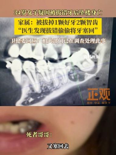 34岁女子疑因被拔错牙后坠楼身亡。家属:被拔掉1颗好牙2颗智齿,医生发现拔错偷偷将牙塞回。