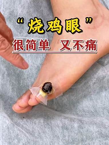鸡眼 艾灸