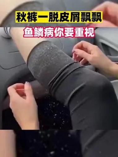 小腿干燥脱屑像蛇皮,鱼鳞病要重视!