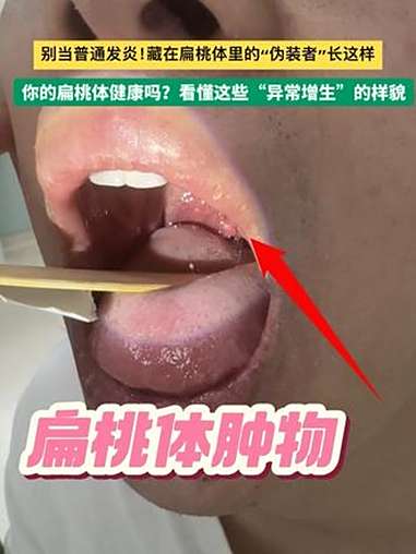 别当普通发炎!藏在扁桃体里的“伪装者”长这样 你的扁桃体健康吗?看懂这些“异常增生”的样貌