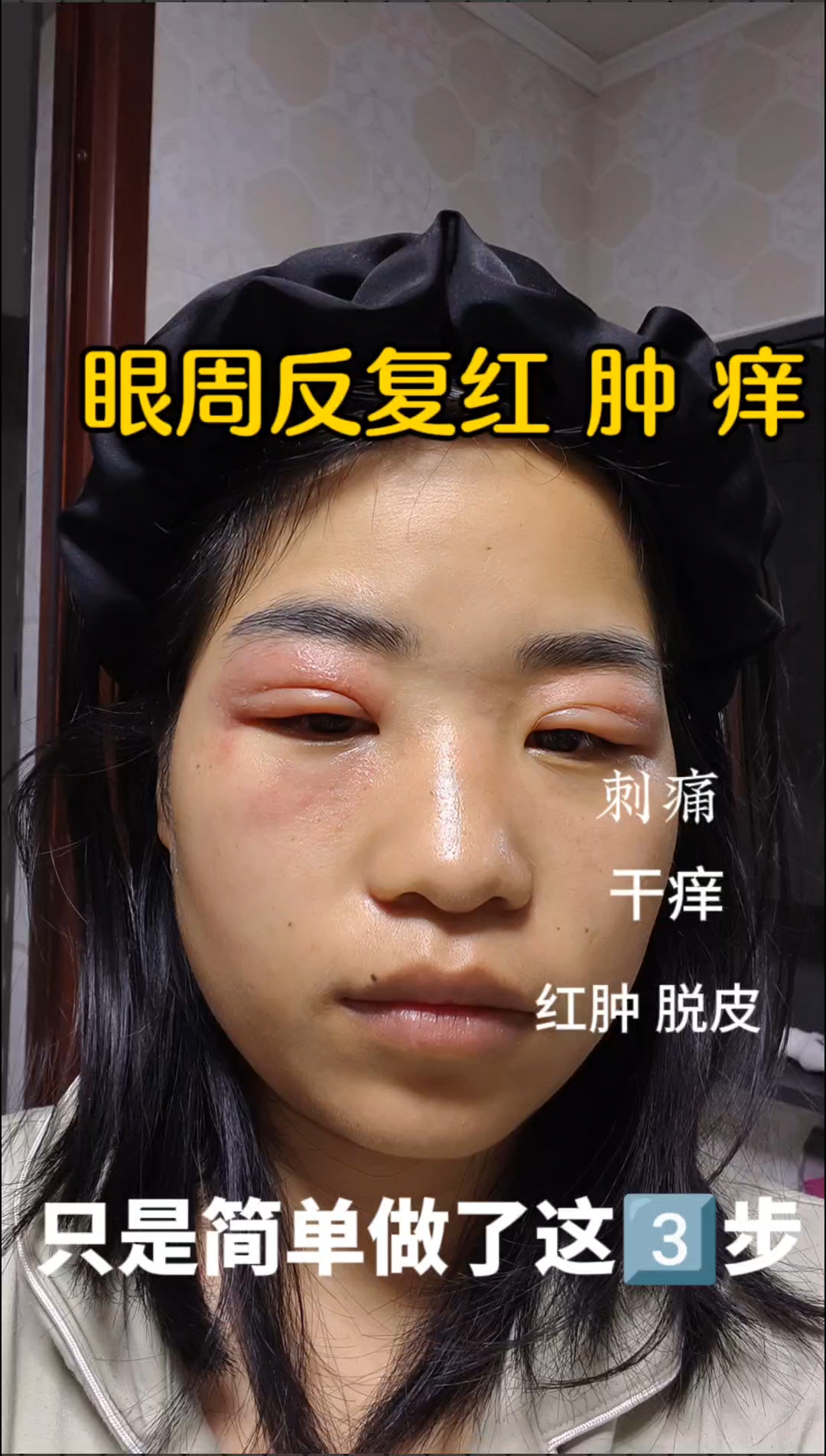 眼周反复红肿痒,刺痛,做好这三步。