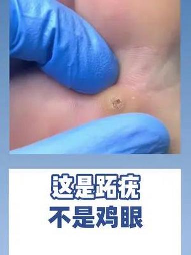 这是HPV感染引起的跖疣 不是鸡眼
