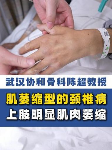 肌萎缩型颈椎病,主典型表现为单侧或双侧上肢手部肌肉萎缩 肌萎缩型颈椎病 颈椎病 上肢肌肉萎