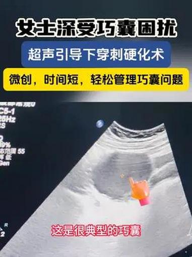 微创,时间短,给更多巧囊患者带来福音!巧囊 女性健康 医学科普 超声介入董刚医生
