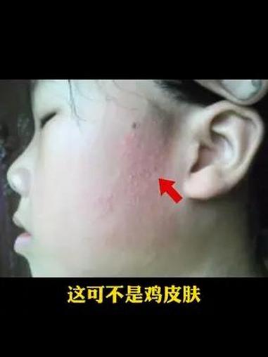 孩子脸上长 小疙瘩,红红的,别再以为是 鸡皮肤 了,这是