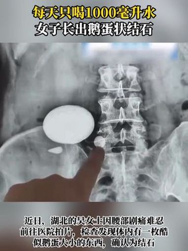 每天只喝1000毫升水,女子长出鹅蛋状结石 结石 肾结石 肾结石科普