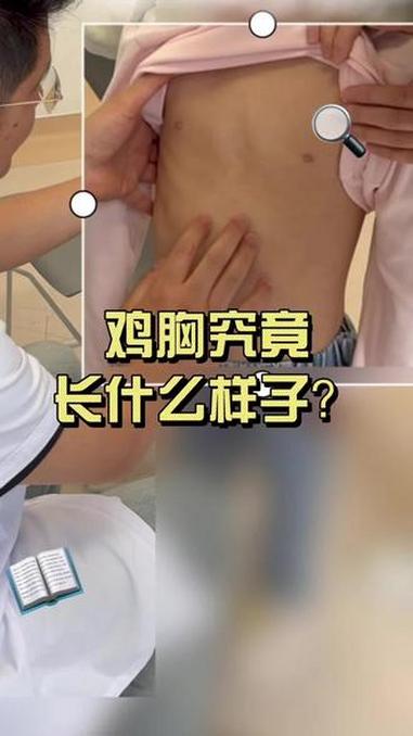 鸡胸究竟长什么样子 #鸡胸 #漏斗胸 #健康科普破圈计划 #抖出健康知识宝藏 #儿童胸外科
