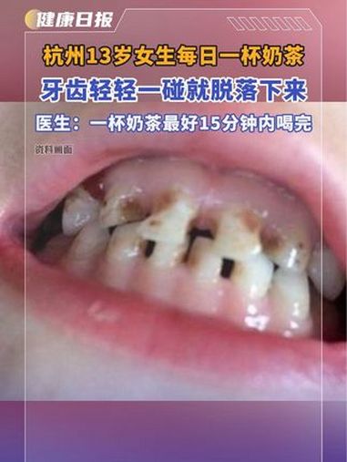 杭州13岁女生每日一杯奶茶 牙齿轻轻一碰就脱落 医生表示:其实奶茶集合了大量的糖,喝奶茶快
