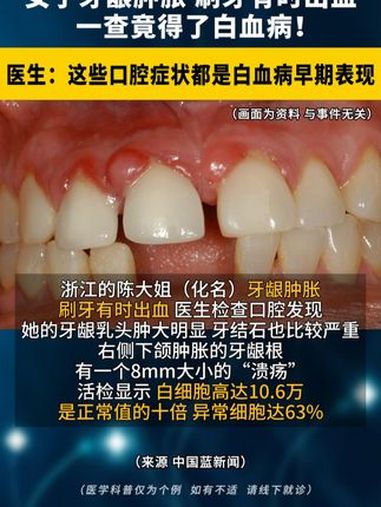 浙江女子牙龈肿胀,刷牙 有时出血,一查竟得了 白血病!医生:这些口腔症状都是白血病早期表现