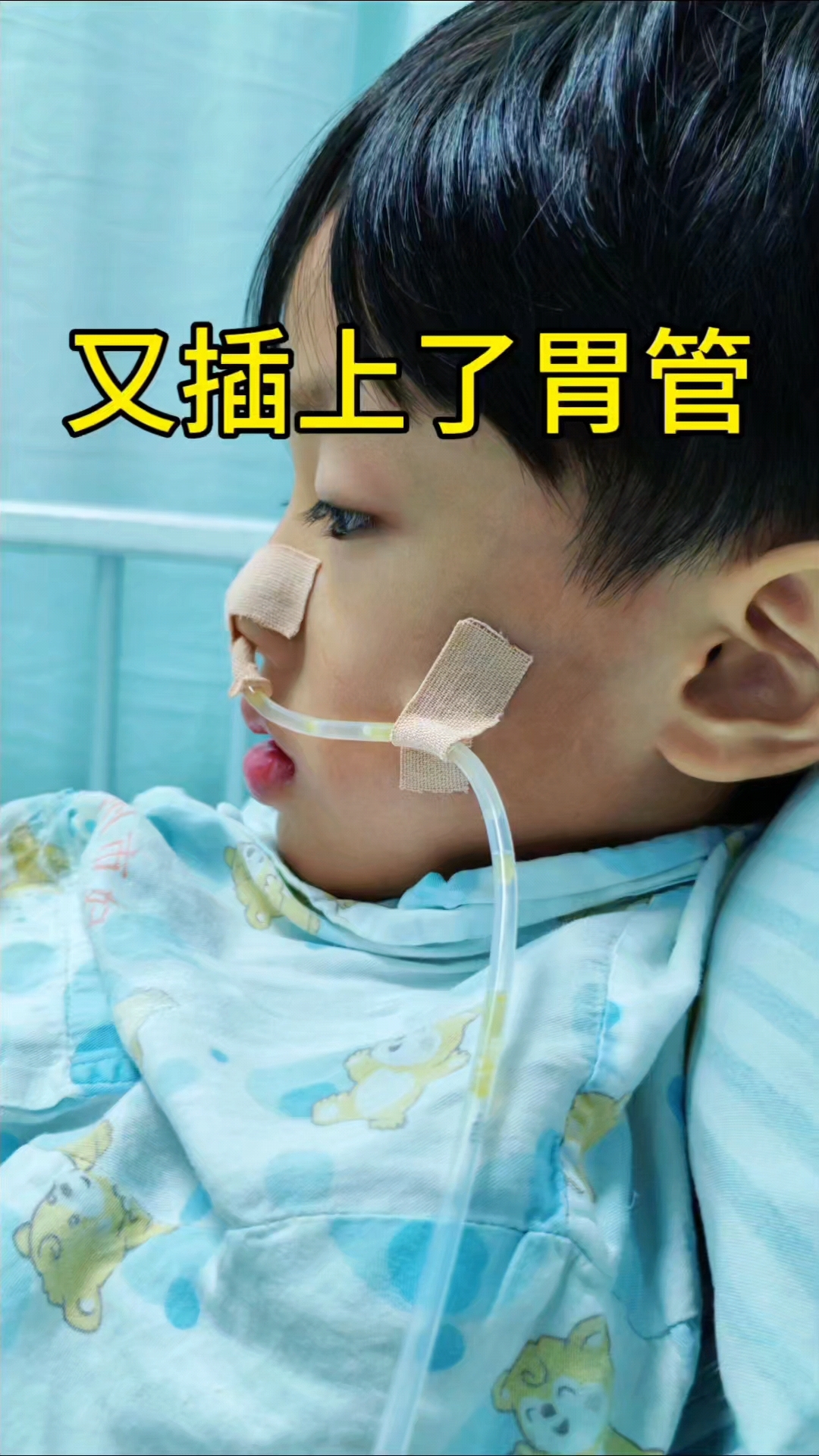 昨晚插胃管的时候,成成又被吓到了,这次的管子比上次大