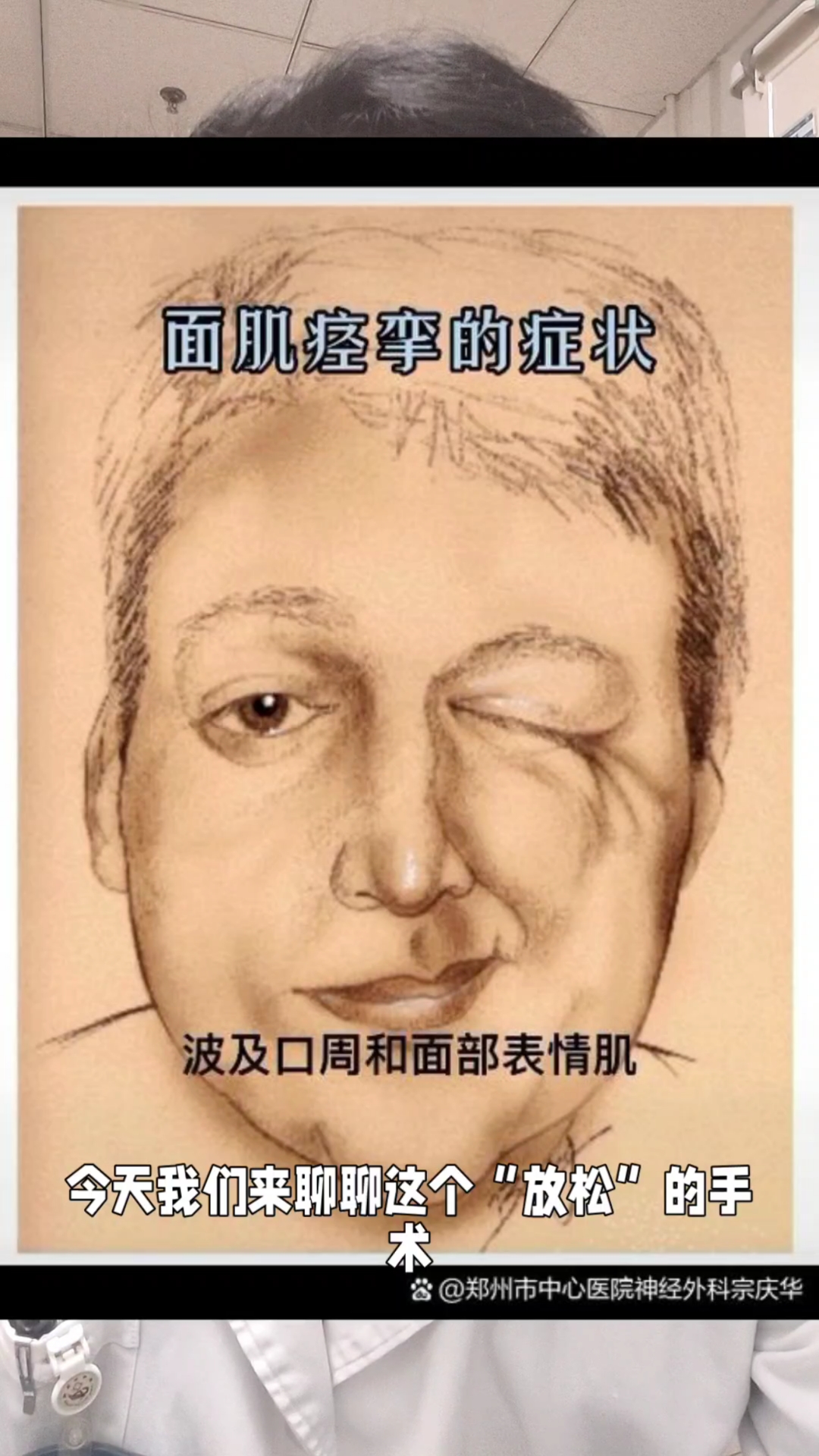 面肌痉挛困扰？试试微血管减压术