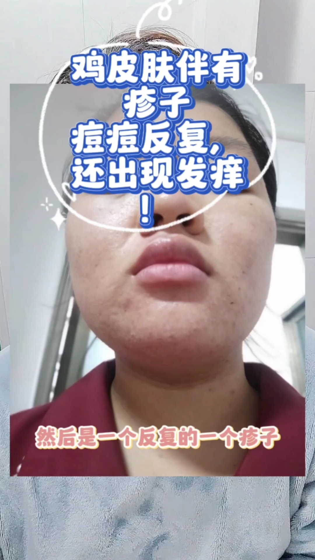 鸡皮肤伴有疹子痘痘反反复复,皮肤还会出现发痒!#鸡皮肤#疹子