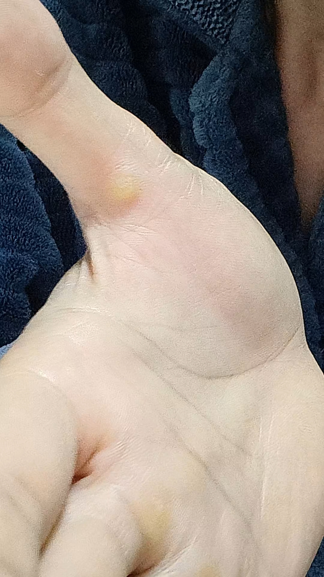 手上长了个鸡眼