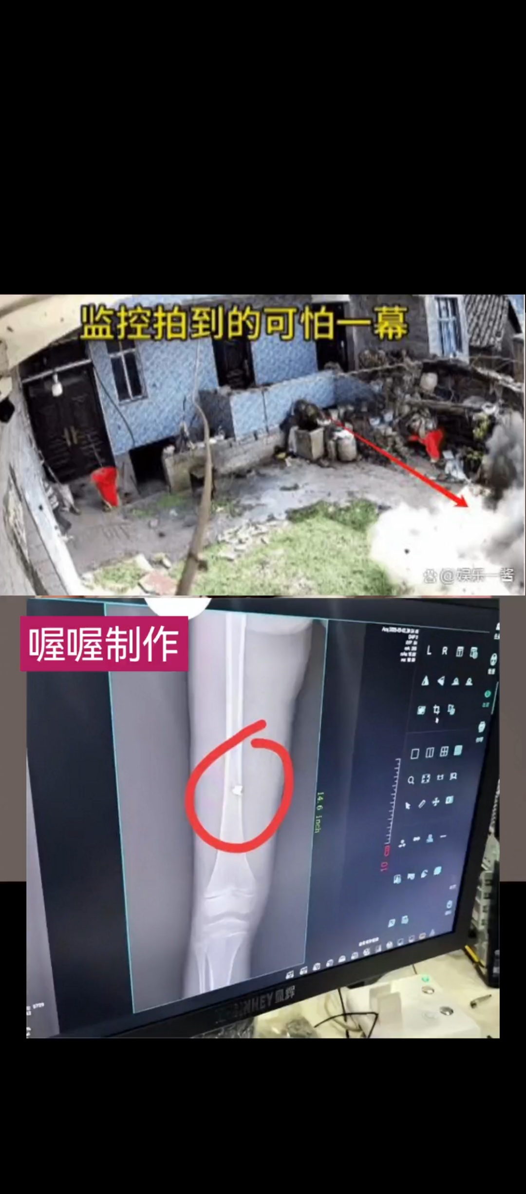 惊险万分。贵州6岁女童引爆手榴弹后续:弹片炸入腿骨。